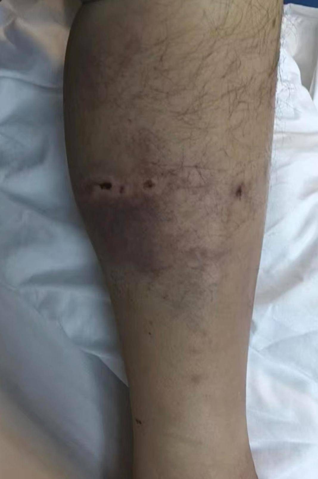 皇冠信用網开户_重庆一男子上山采菌后遇熊袭击皇冠信用網开户,幸亏穿了雨靴!20余名村民连夜救援