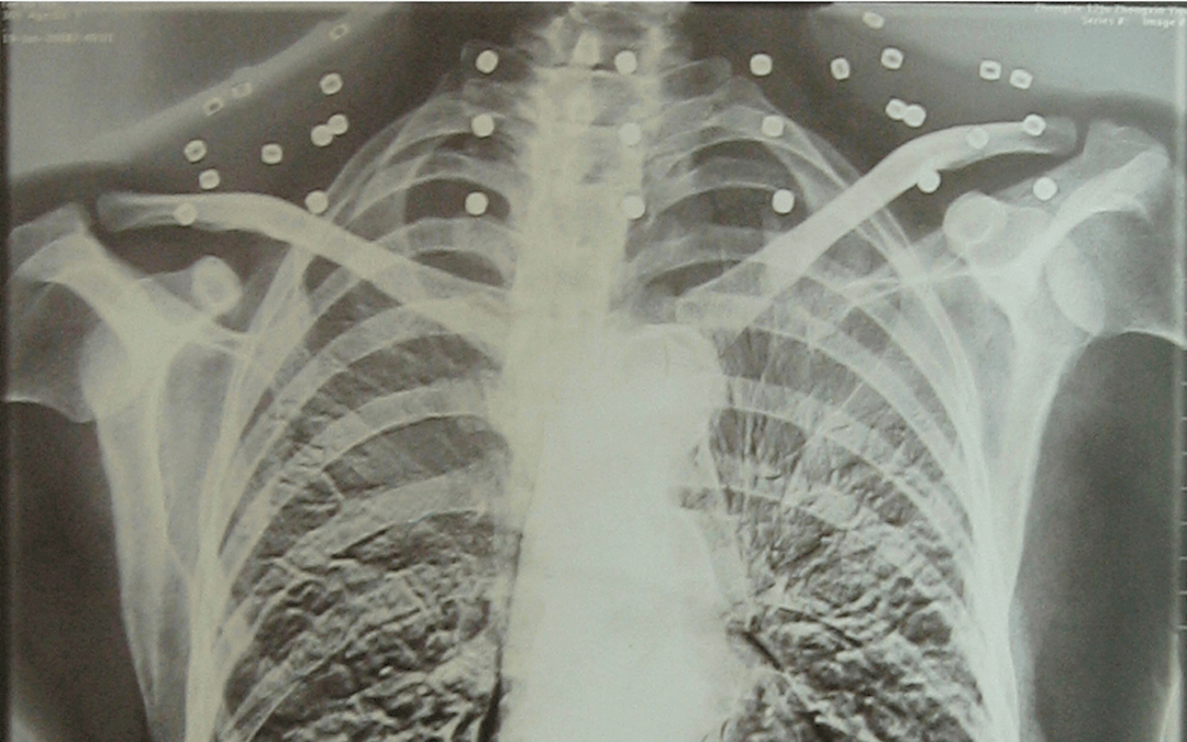 皇冠登一登二登三区别_“老先生皇冠登一登二登三区别,您把项链取下来再做CT”